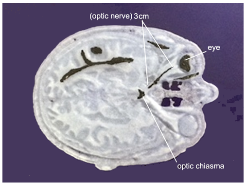 A 3D print of a transverse section of a human head with parts of the brain covered in black electric paint, including an eye, an optic nerve and optic chiasma.