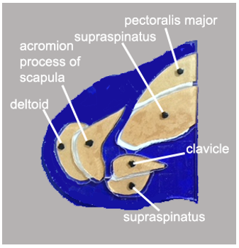 A stratographic diagram of the transverse section of a human left shoulder, with parts labeled, deltoid, acromion process of scapula, supraspinatus, pectoralis major, clavicle, supraspinatus.